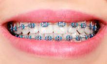 Brace Price In Pakistan