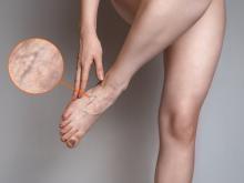 Spider Vien Treatment in Islamabad