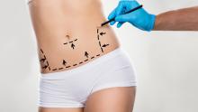 liposuction