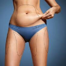 جراحة شفط الدهون في دبي