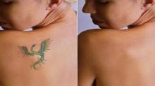 إزالة الوشم في دبي