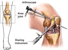 Arthroscopy surgery in India