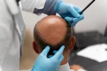 زراعة الشعر في دبي