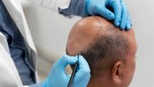 hairtransplant,inriyadh