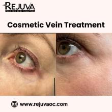 Cosmetic Vein Treatment in Newport Beach