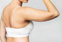 Liposuction in Dubai