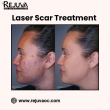 Laser Scar Treatment in Newport Beach