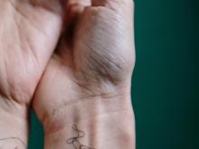 Stress Rheumatoid Arthritis