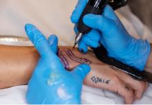 Tattoo Removal
