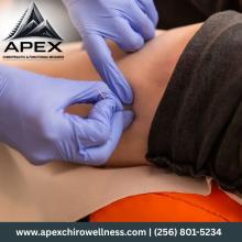 Dry Needling Downtown Huntsville