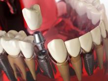 Dentist explaining dental implants treatment
