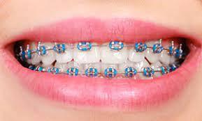 Brace Price In Pakistan