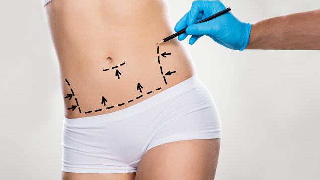 liposuction