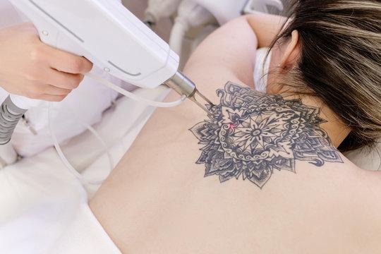 Laser Tattoo Removal in Dubai