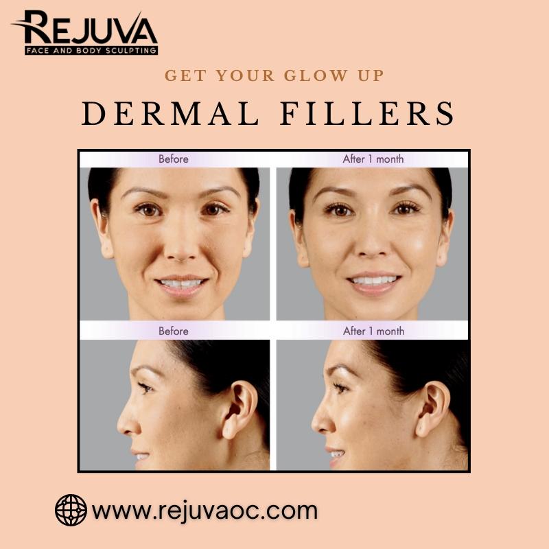 Dermal Fillers 