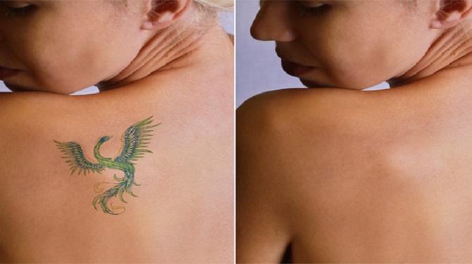 إزالة الوشم في دبي