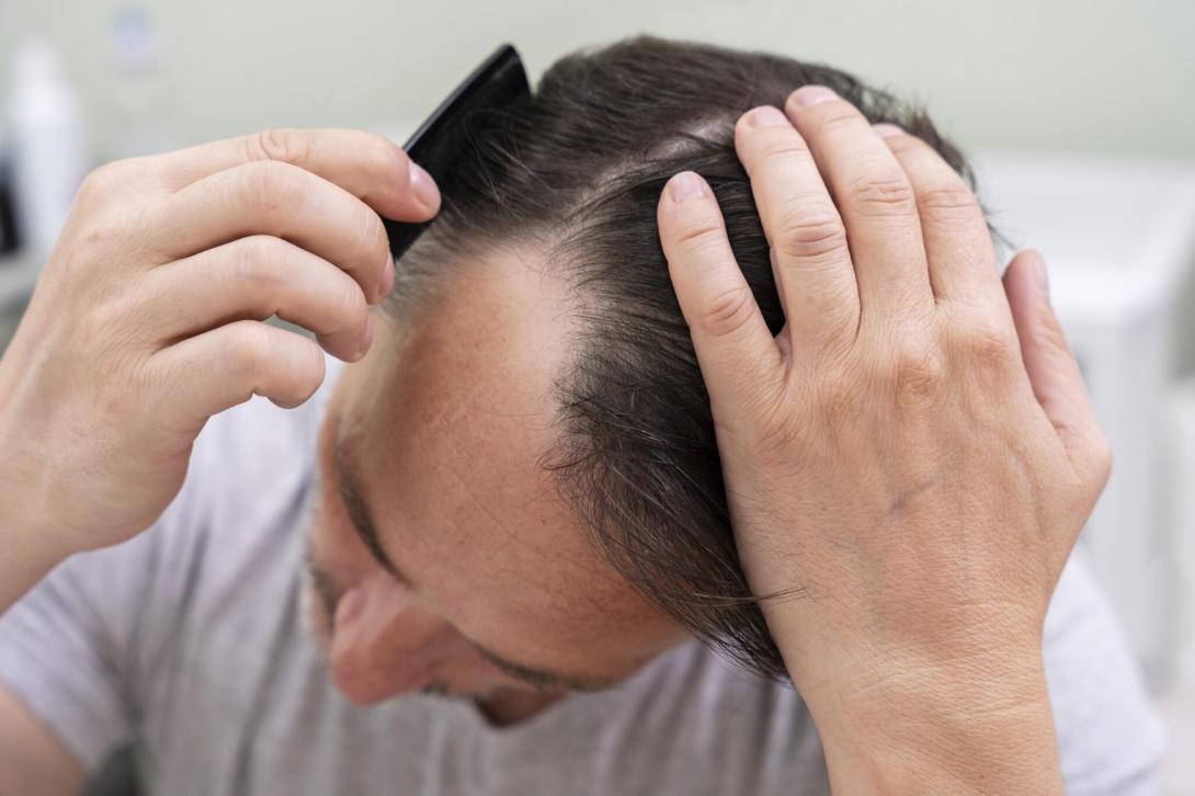 male hair loss Seattle