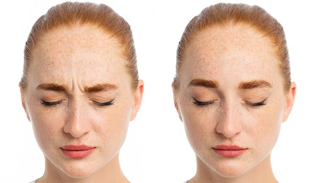 botox bekymringsrynke