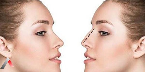  عملية تجميل الأنف في الرياض