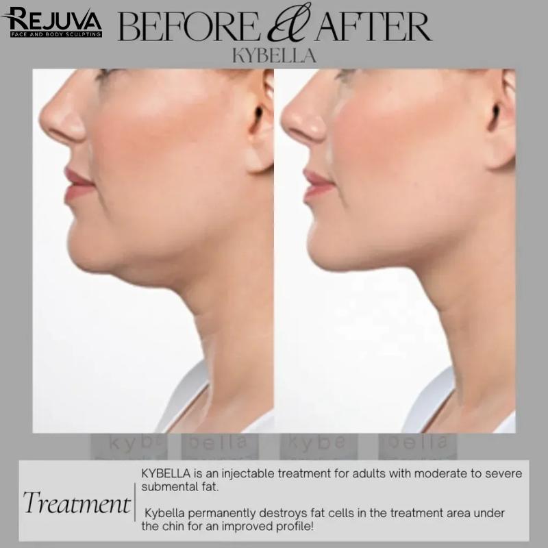 KybellaInjections, Rejuvaoc, DoubleChinRemoval, KybellaTreatment, NonSurgicalContour, FacialSculpting, BeautyEnhancement,