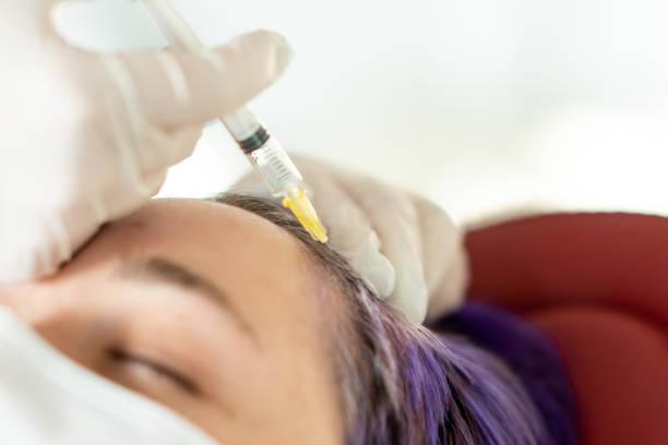 PRP hair treatment in Dubai