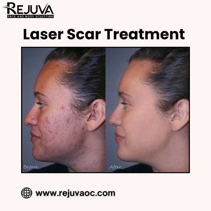 Laser Scar Treatment in Newport Beach