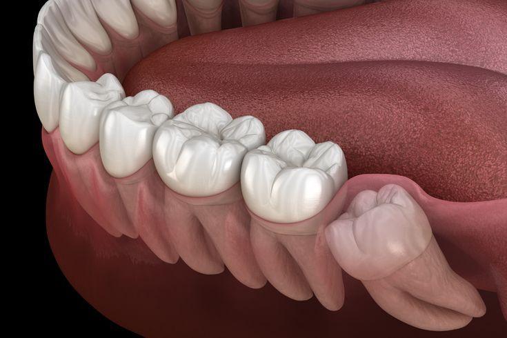 wisdom teeth removal in Paschim Vihar