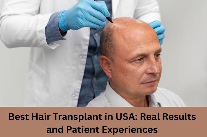 Best Hair Transplant in USA: Real Results and Patient Experiences