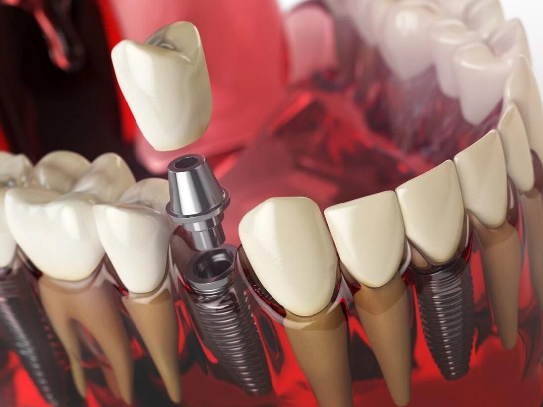 Dentist explaining dental implants treatment