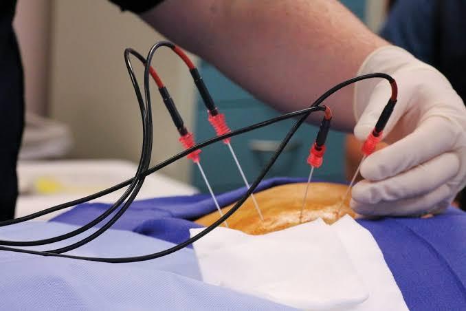 radiofrequency ablation uk
